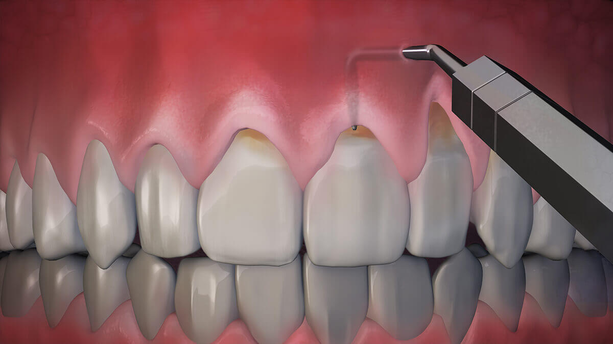 gum specialist tyler tx