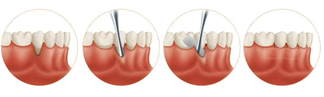soft tissue grafting in periodontics